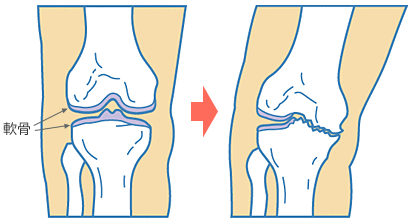 変形性膝関節症