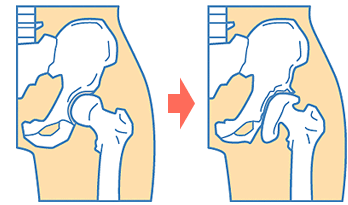 変形性股関節症